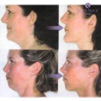 Масажер для щік InnovaGoods для зменшення подвійного підборіддя