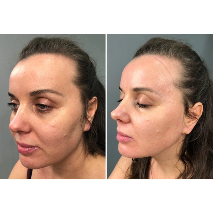 Мікрострумовий ліфтинг MEDICA+ Skin Lifting 6.0 pink (Japan)