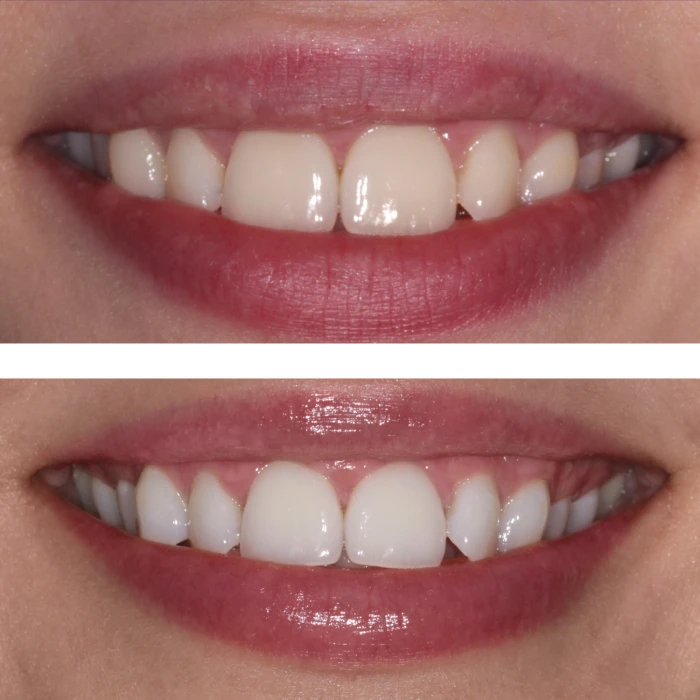 Отбеливающий корректор для цвета зубов MEDICA+ V34