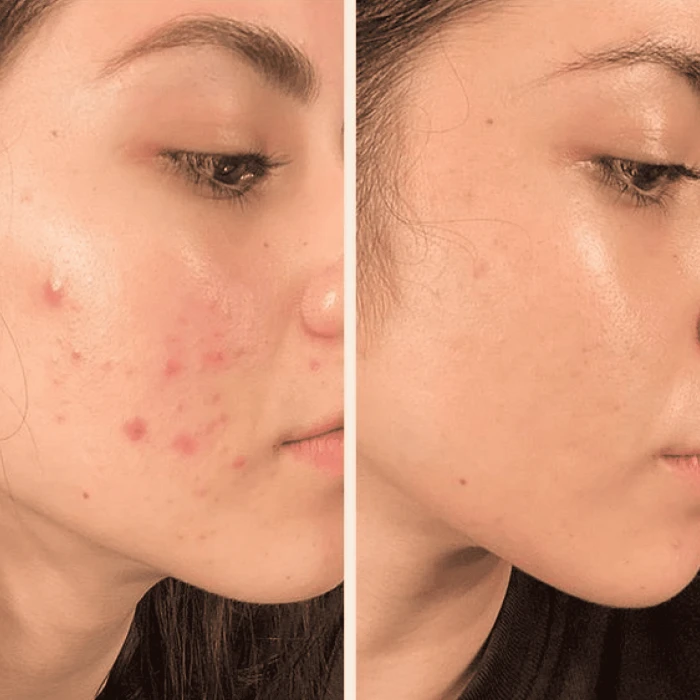 Портативный дарсонваль DARSOLINE 4.0 + Суспензия Antibacterial suspension + Успокаивающая маска для лица Soothing Mask MEDICA+ (Japan)