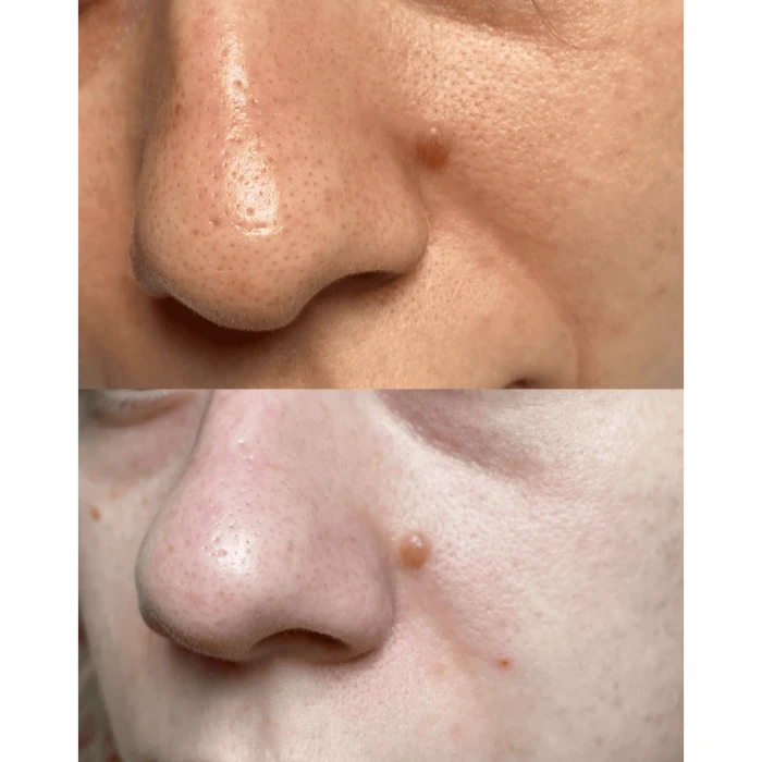 Ультразвуковой скраббер для кожи лица MEDICA+ Vibroskin 5.0 (Japan)