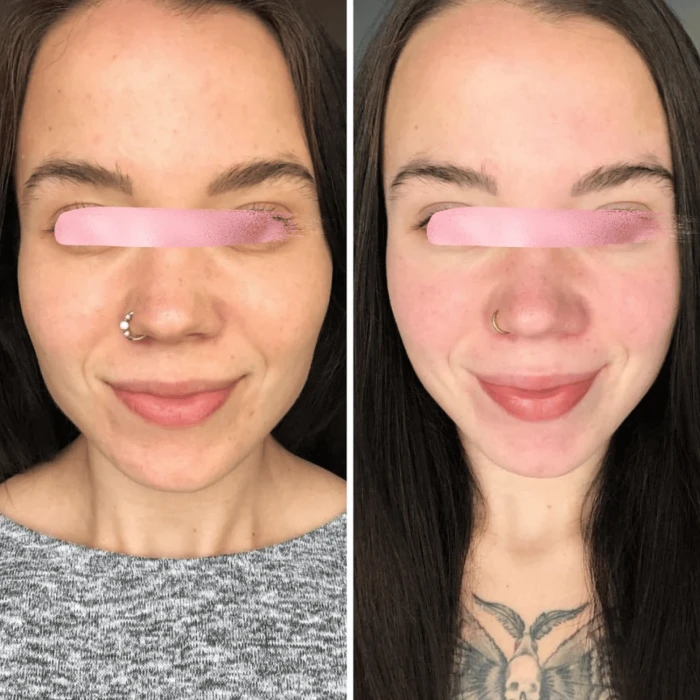 Мікрострумовий ліфтинг MEDICA+ Skin Lifting 6.0 pink (Japan)