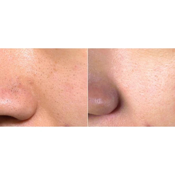 Ультразвуковой скраббер MEDICA+ Lux SuperSonic 10