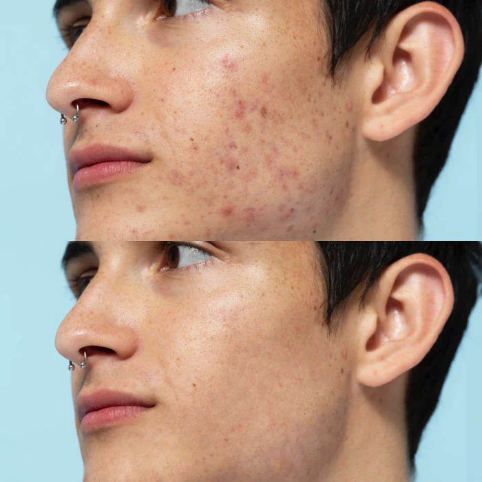 Ультразвуковой скраббер для лица MEDICA+ Vibroskin 5.0 + инструменты для чистки лица (Japan)