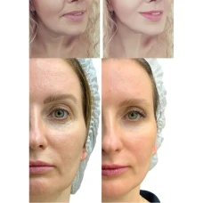 Мікрострумовий RF Lifting Масажер для обличчя Skin Lifting 7.0 Pink - EMS, LED (Japan)
