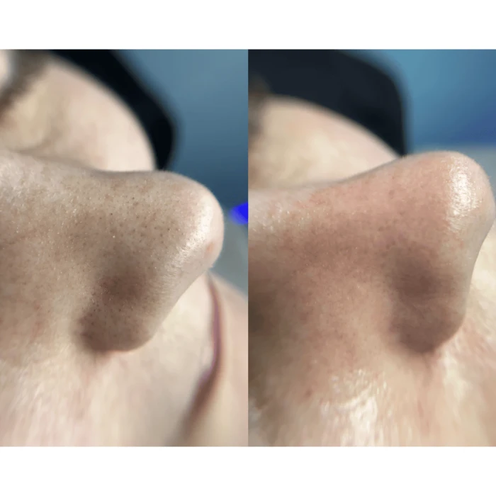 Ультразвуковой скраббер для кожи лица MEDICA+ Vibroskin 8.0 (Japan)