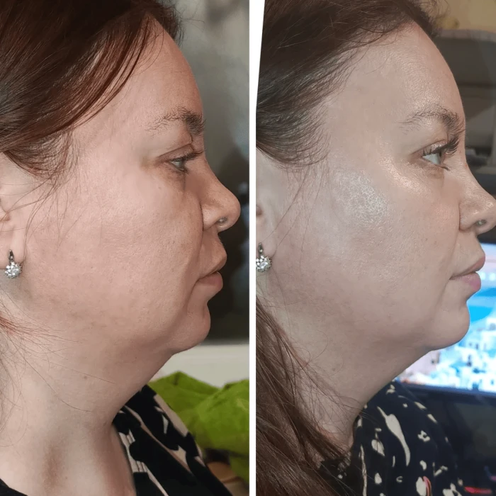 Микротоковый RF Lifting Массажер для лица Skin Lifting 7.0 Pink - EMS, LED (Japan)