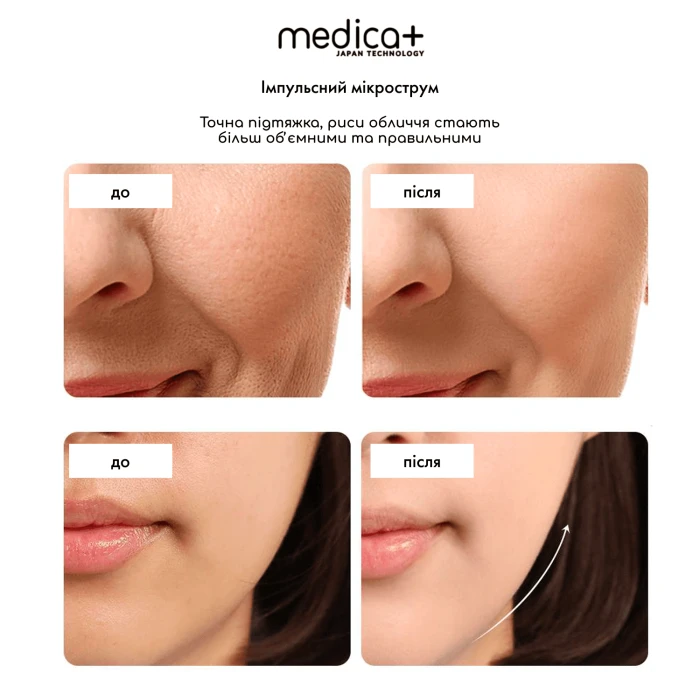 Масажер для обличчя MEDICA+ SkinLifting PRO 10x з мікрострумом, RF та функцією ліфтингу