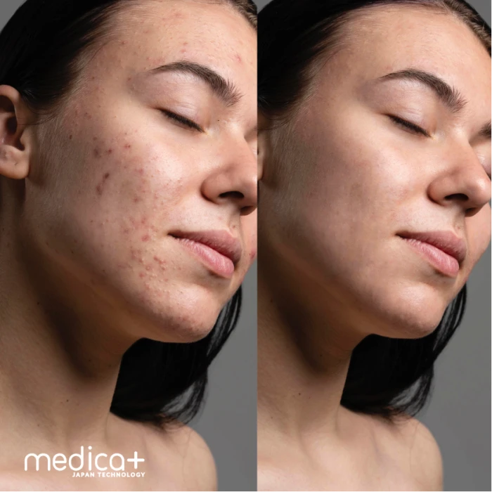 Вакуумный очиститель кожи и пор Medica+ SKINCLEANER 9.0 BL