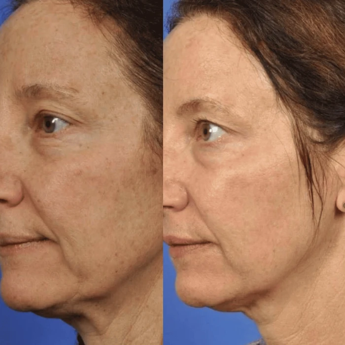 Токопроводящий гель MEDICA+ Conductive Lifting Gel (100 мл)