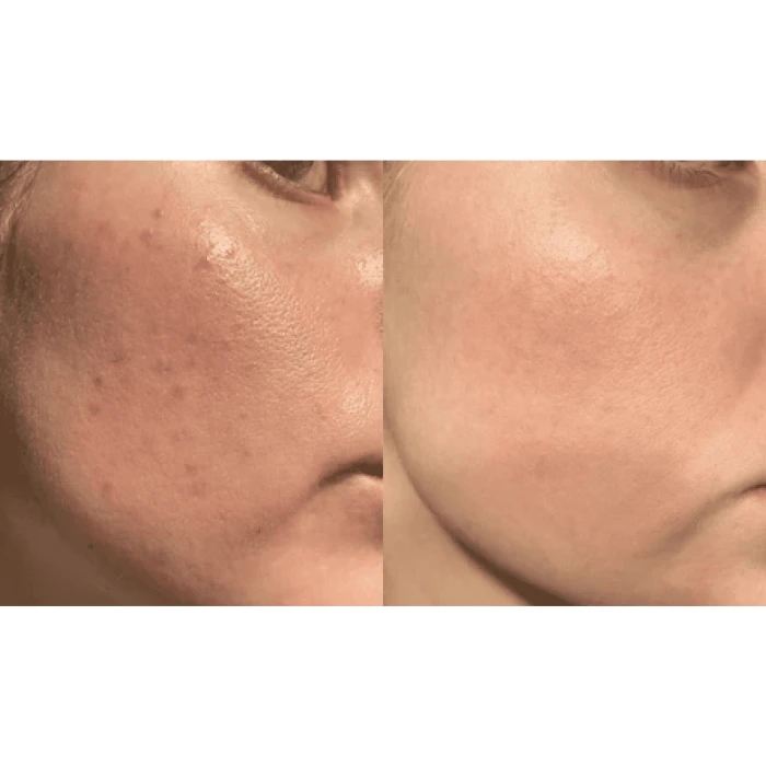 Портативный дарсонваль MEDICA+ DARSOLINE 4.0 Сase Pro (Japan)