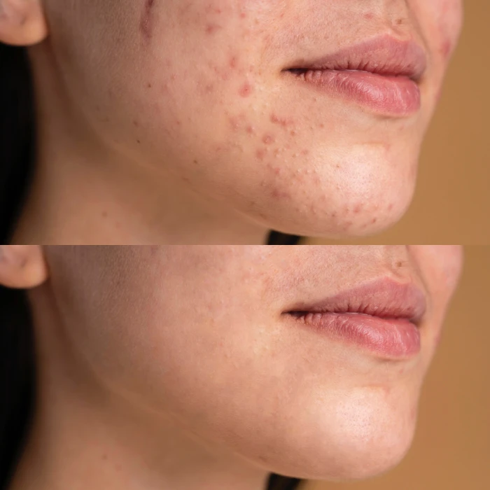 Портативный дарсонваль MEDICA+ DARSOLINE 7.0 Сase Pro (Japan)