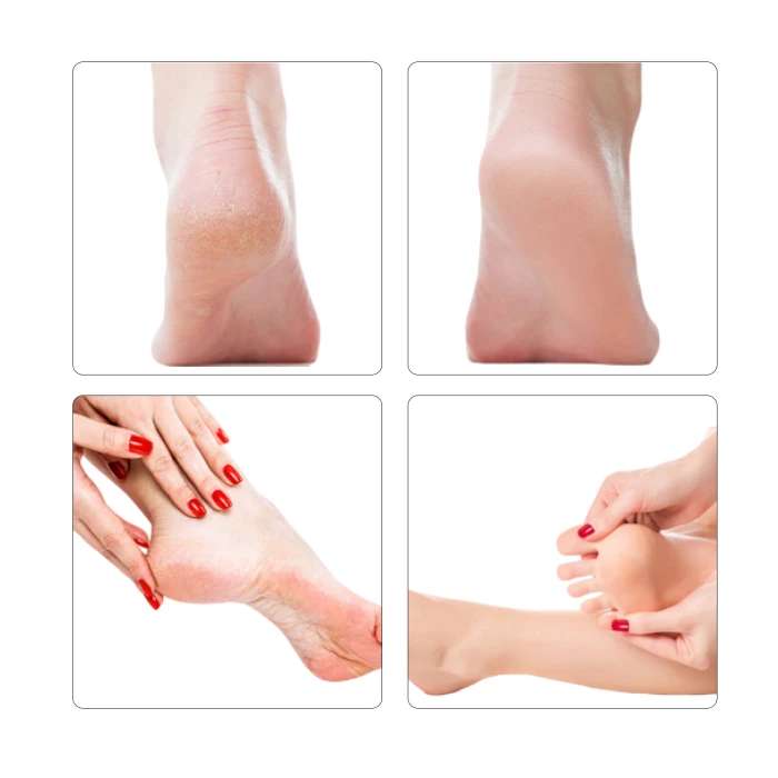 Электрическая роликовая пилка-пемза 4в1 MEDICA+ BodyControl 4v1 (Japan)